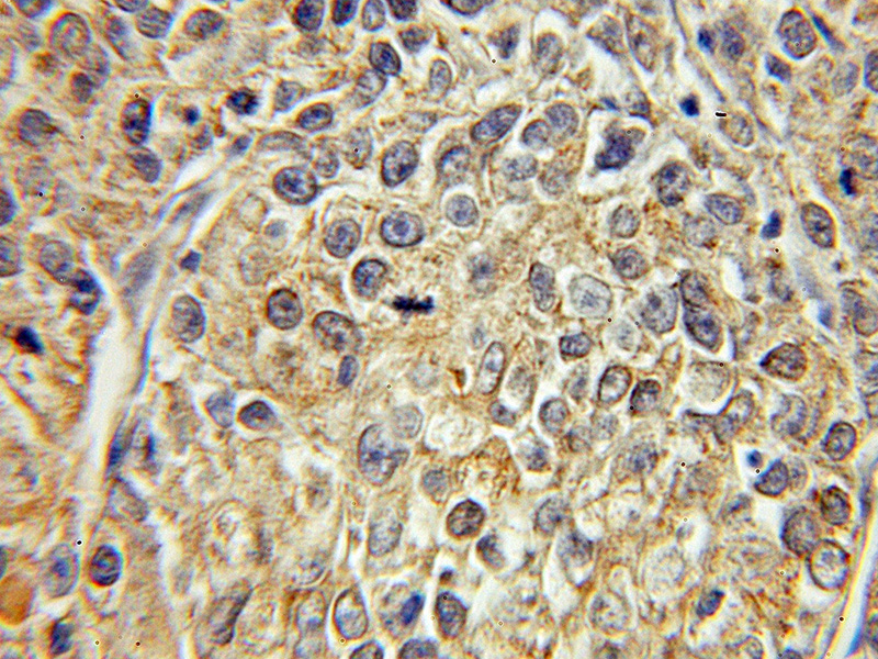 Immunohistochemical of paraffin-embedded human lung cancer using Catalog No:110441(FABP5 antibody) at dilution of 1:50 (under 10x lens)