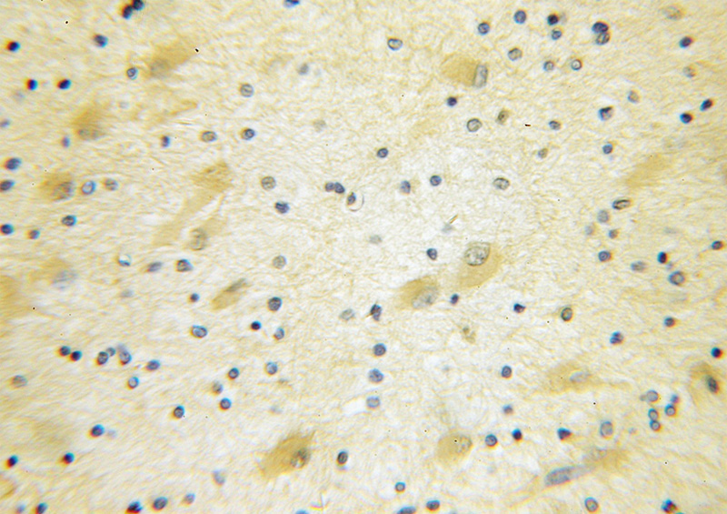 Immunohistochemical of paraffin-embedded human gliomas using Catalog No:110264(EIF4G3 antibody) at dilution of 1:10 (under 10x lens)