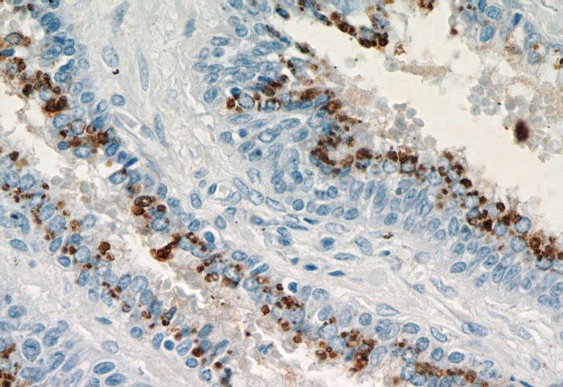 Immunohistochemical of paraffin-embedded human prostate hyperplasia using Catalog No:113928(PLA2G4F antibody) at dilution of 1:200 (under 40x lens)