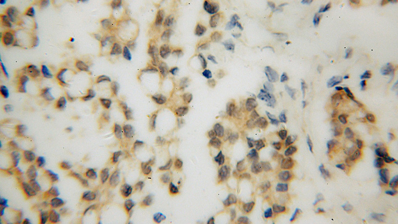 Immunohistochemical of paraffin-embedded human ovary tumor using Catalog No:114795(RPAIN antibody) at dilution of 1:50 (under 40x lens)