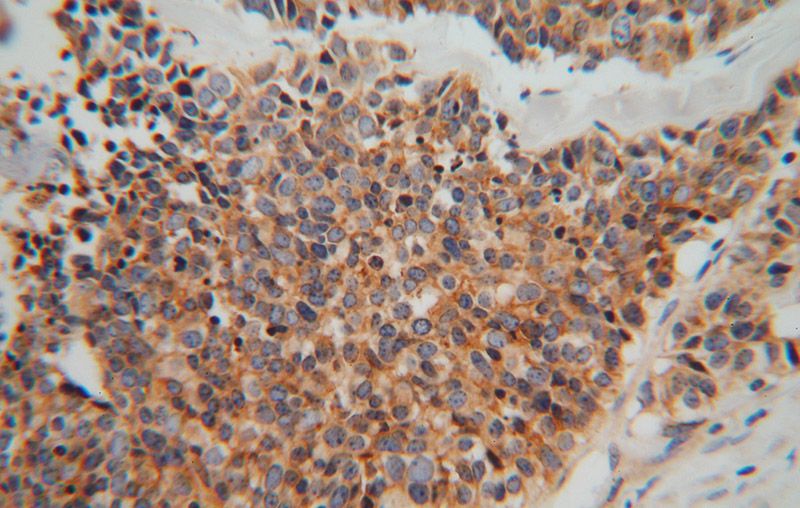 Immunohistochemical of paraffin-embedded human lung cancer using Catalog No:112477(MARCKSL1 antibody) at dilution of 1:50 (under 40x lens)