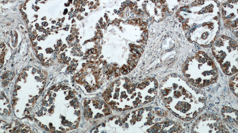 Immunohistochemical of paraffin-embedded human lung cancer using Catalog No:114678(REDD1 antibody) at dilution of 1:50 (under 10x lens)