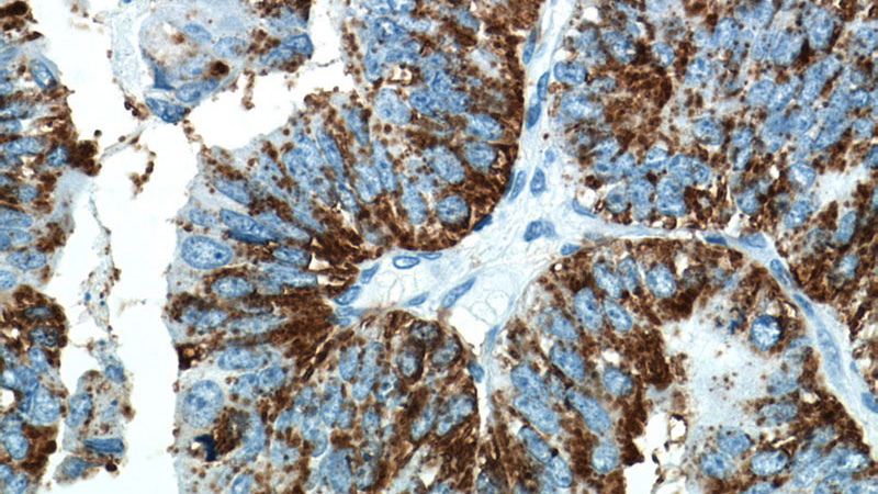 Immunohistochemistry of paraffin-embedded human ovary tumor tissue slide using Catalog No:114222(SERPINA5 Antibody) at dilution of 1:50 (under 40x lens)
