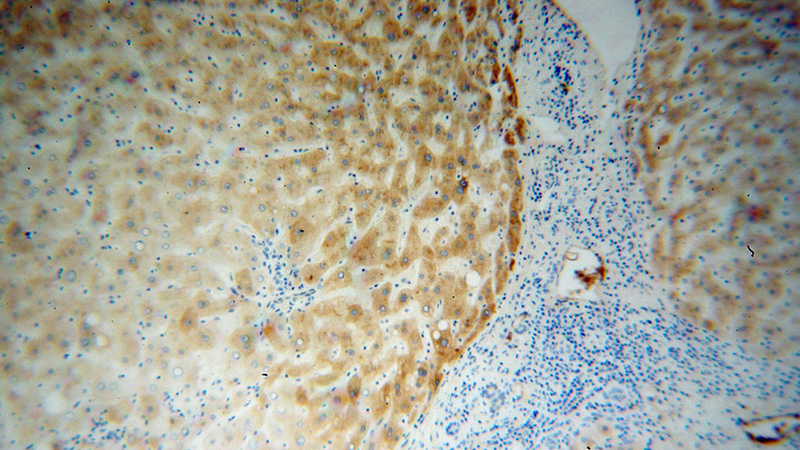 Immunohistochemical of paraffin-embedded human liver cancer using Catalog No:114179(TTR antibody) at dilution of 1:100 (under 10x lens)