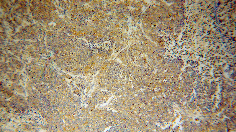 Immunohistochemical of paraffin-embedded human lung cancer using Catalog No:114970(SARS antibody) at dilution of 1:100 (under 10x lens)
