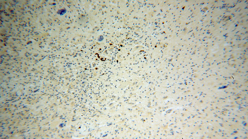 Immunohistochemical of paraffin-embedded human gliomas using Catalog No:112013(KIF3A antibody) at dilution of 1:100 (under 10x lens)