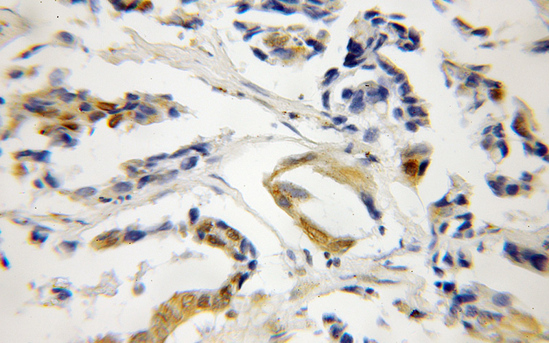 Immunohistochemical of paraffin-embedded human lung cancer using Catalog No:109089(TSPYL2,TSPX,NP79 antibody) at dilution of 1:50 (under 40x lens)