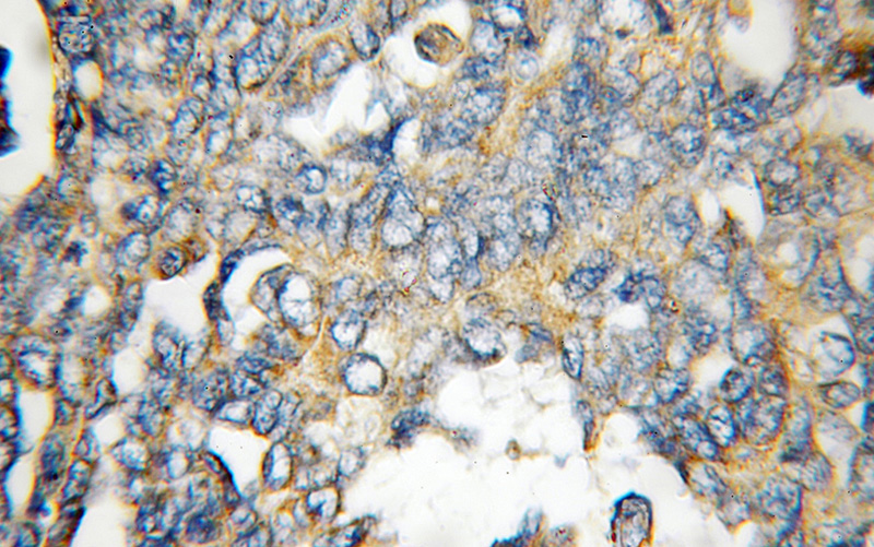 Immunohistochemical of paraffin-embedded human ovary tumor using Catalog No:110649(FHL1 antibody) at dilution of 1:100 (under 10x lens)