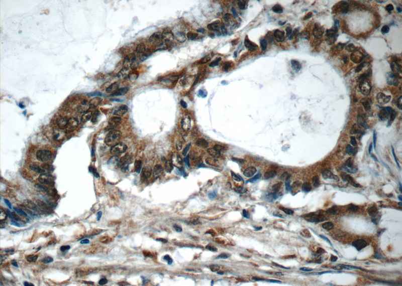 Immunohistochemistry of paraffin-embedded human colon cancer tissue slide using Catalog No:115417(SMAD3 Antibody) at dilution of 1:50 (under 40x lens)