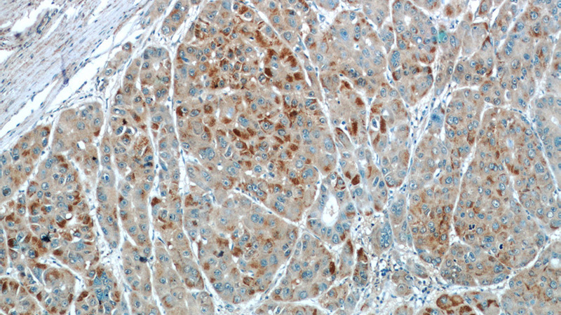 Immunohistochemistry of paraffin-embedded human liver cancer slide using Catalog No:110205(EFCAB5 Antibody) at dilution of 1:50