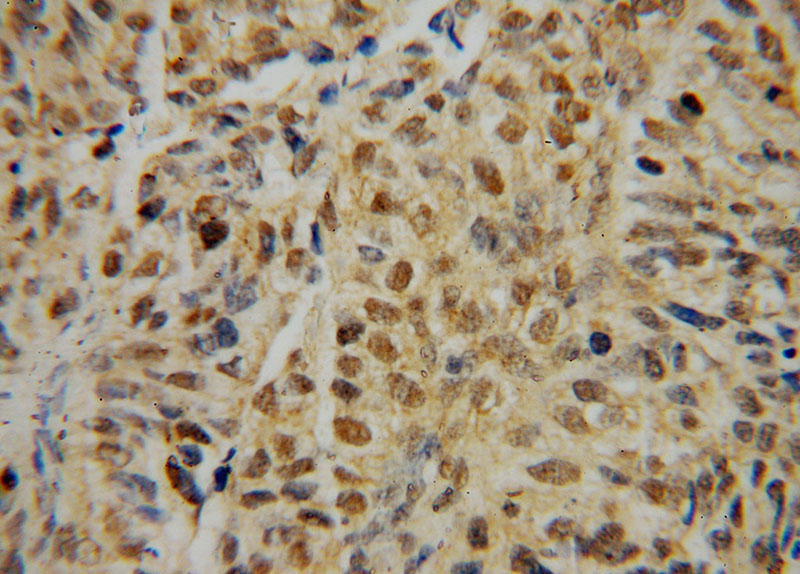Immunohistochemical of paraffin-embedded human colon cancer using Catalog No:111832(IRF2 antibody) at dilution of 1:50 (under 40x lens)