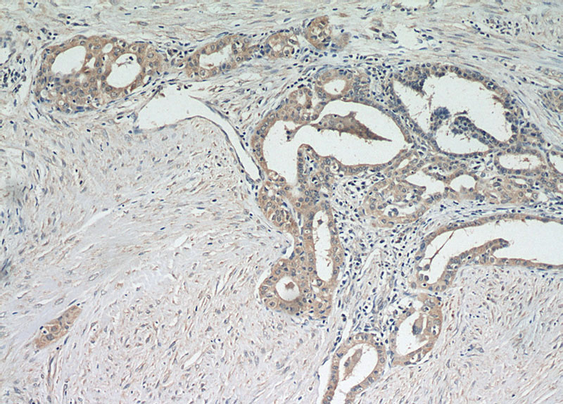 Immunohistochemical of paraffin-embedded human thyroid cancer using Catalog No:113850(PRKCE antibody) at dilution of 1:100 (under 10x lens)
