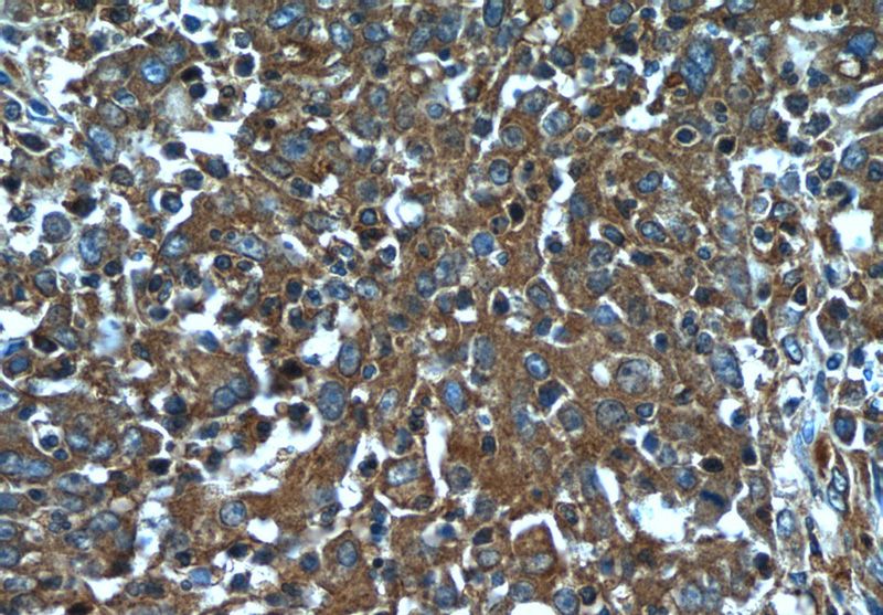 Immunohistochemistry of paraffin-embedded human colon cancer tissue slide using Catalog No:112129(KRT23 Antibody) at dilution of 1:50 (under 40x lens)