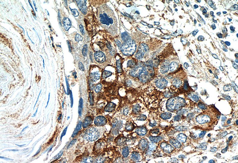 Immunohistochemistry of paraffin-embedded human cervical cancer tissue slide using Catalog No:109663(CCNB2 Antibody) at dilution of 1:200 (under 40x lens)