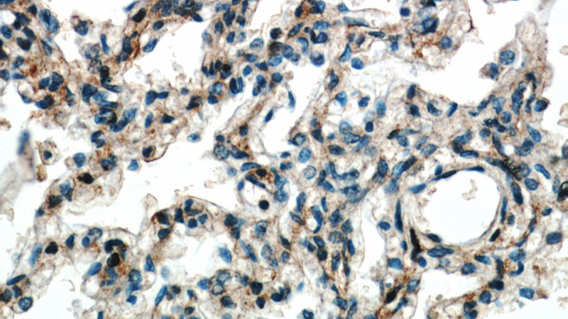 Immunohistochemical of paraffin-embedded human lung using Catalog No:110628(FGD5 antibody) at dilution of 1:100 (under 40x lens)