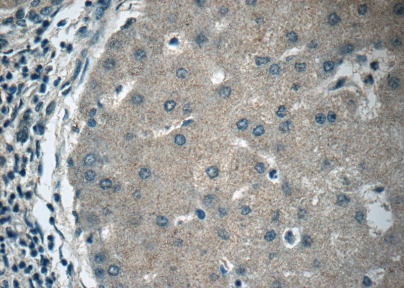 Immunohistochemistry of paraffin-embedded human hepatocirrhosis tissue slide using Catalog No:108039(APOM Antibody) at dilution of 1:50 (under 40x lens)