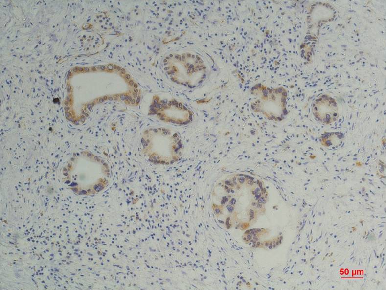 Immunohistochemical analysis of paraffin-embedded Human Pancreatic Carcinoma usingCyclophilin B Mouse mAb diluted at 1:200.