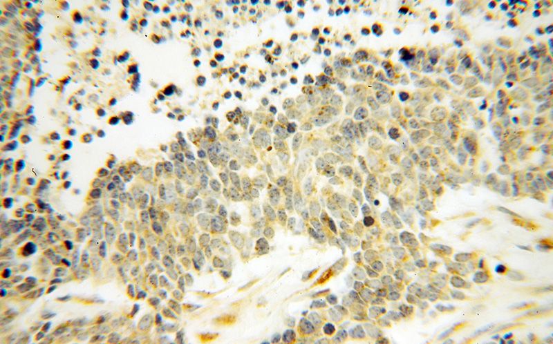 Immunohistochemical of paraffin-embedded human lung cancer using Catalog No:109900(DEXI antibody) at dilution of 1:100 (under 40x lens)