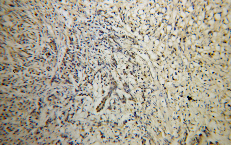 Immunohistochemical of paraffin-embedded human prostate cancer using Catalog No:116462(U2AF35 antibody) at dilution of 1:100 (under 10x lens)