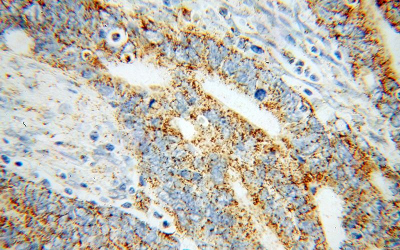 Immunohistochemical of paraffin-embedded human liver cancer using Catalog No:112543(MCCC1 antibody) at dilution of 1:100 (under 40x lens)