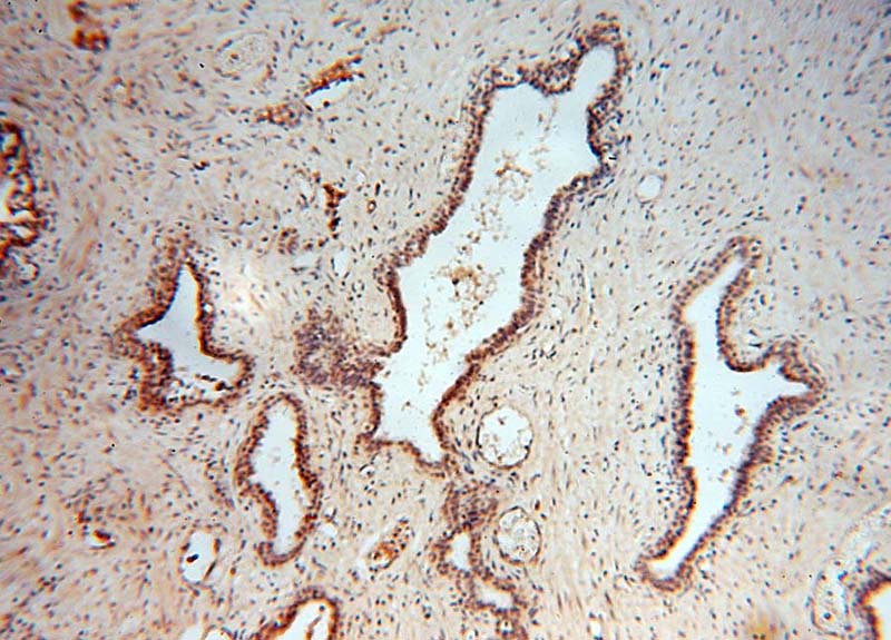 Immunohistochemical of paraffin-embedded human prostate cancer using Catalog No:110410(EXOSC3 antibody) at dilution of 1:50 (under 10x lens)
