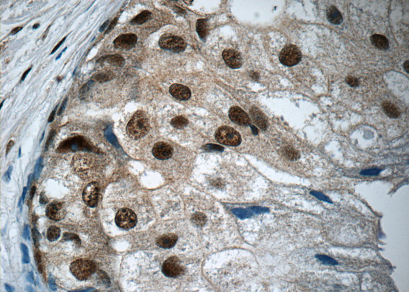 Immunohistochemistry of paraffin-embedded human breast cancer tissue slide using Catalog No:107354(IRF5 Antibody) at dilution of 1:50 (under 40x lens)