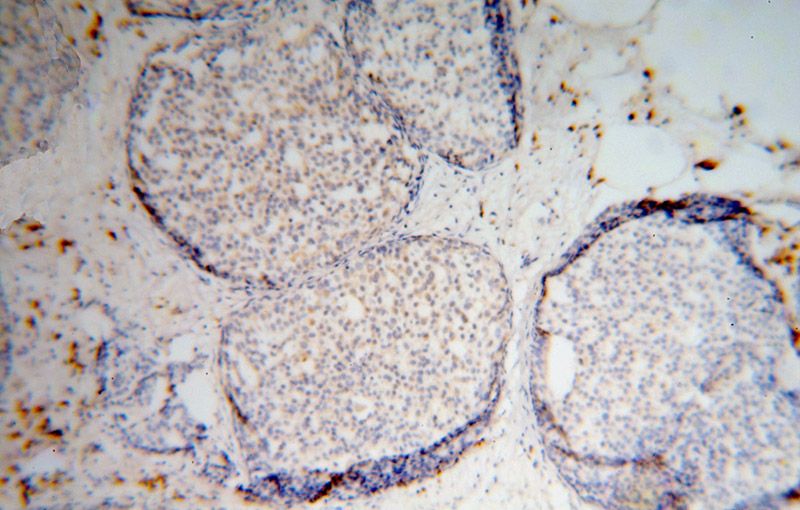 Immunohistochemical of paraffin-embedded human breast cancer using Catalog No:114831(RPS16 antibody) at dilution of 1:50 (under 10x lens)