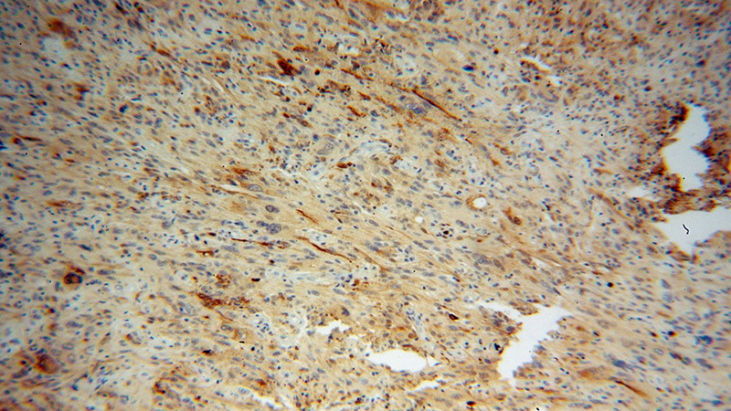 Immunohistochemical of paraffin-embedded human gliomas using Catalog No:113791(PGM2L1 antibody) at dilution of 1:50 (under 10x lens)