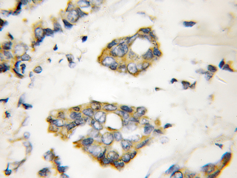 Immunohistochemical of paraffin-embedded human breast cancer using Catalog No:112621(MIG6; ERRFI1 antibody) at dilution of 1:50 (under 10x lens)