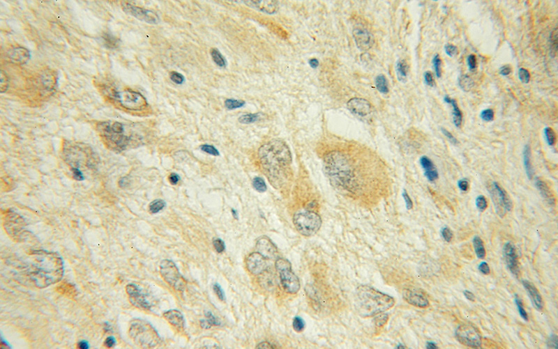 Immunohistochemical of paraffin-embedded human gliomas using Catalog No:109702(CYP46A1 antibody) at dilution of 1:50 (under 10x lens)