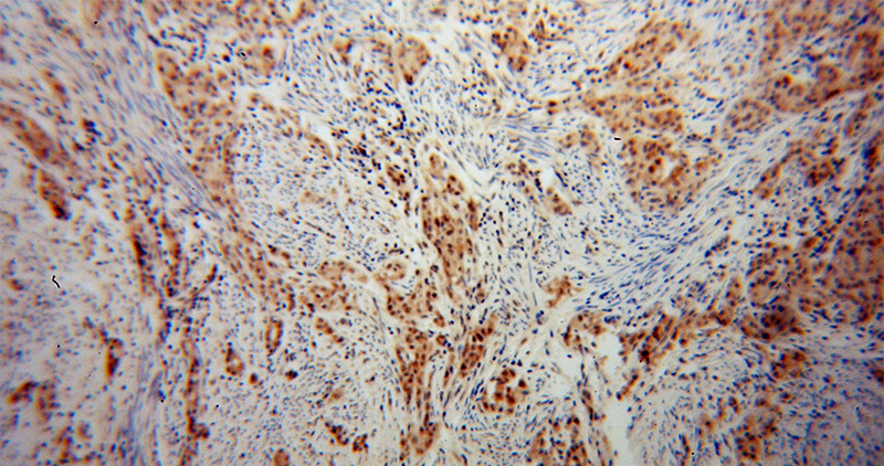 Immunohistochemical of paraffin-embedded human endometrial cancer using Catalog No:109224(CHFR antibody) at dilution of 1:100 (under 10x lens)
