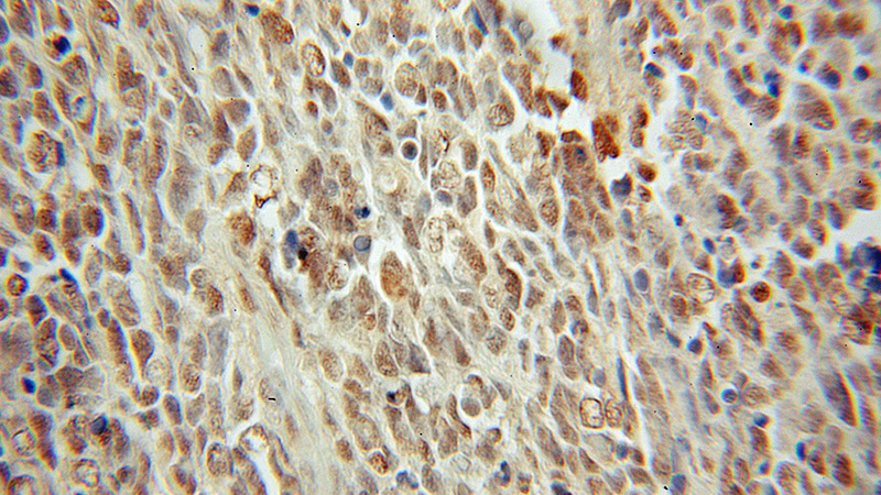 Immunohistochemical of paraffin-embedded human medulloblastoma using Catalog No:108405(SMARCC2 antibody) at dilution of 1:50 (under 10x lens)