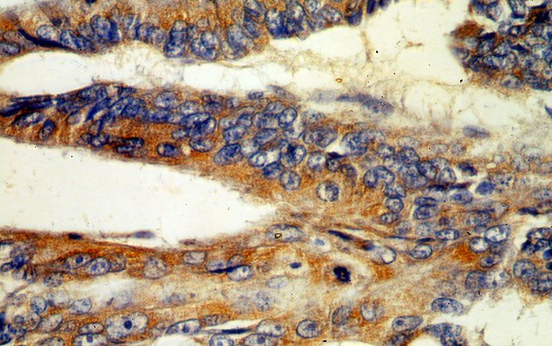 Immunohistochemical of paraffin-embedded human colon cancer using Catalog No:112537(MGAT3 antibody) at dilution of 1:50 (under 40x lens)