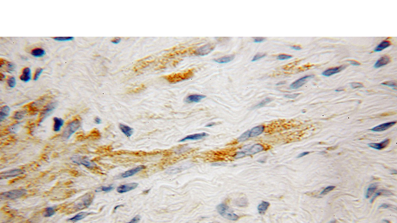 Immunohistochemical of paraffin-embedded human endometrial cancer using Catalog No:114498(RABGEF1 antibody) at dilution of 1:100 (under 10x lens)