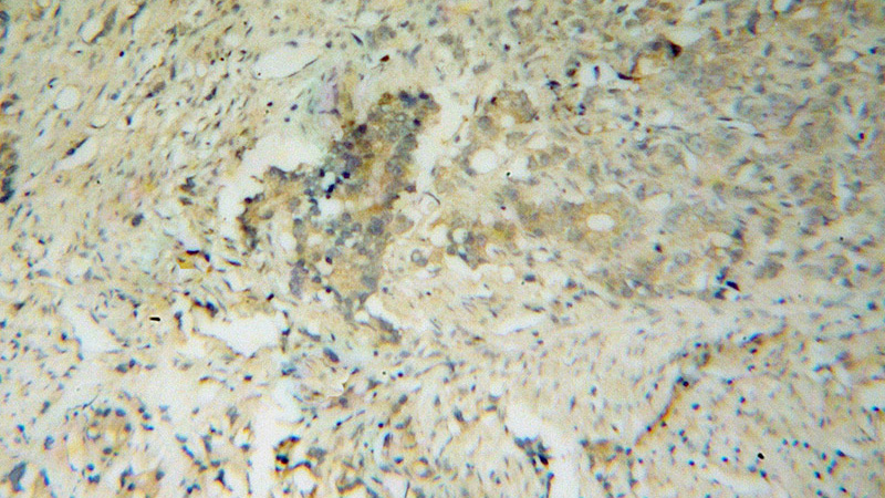 Immunohistochemical of paraffin-embedded human gliomas using Catalog No:112001(KIF17 antibody) at dilution of 1:100 (under 10x lens)