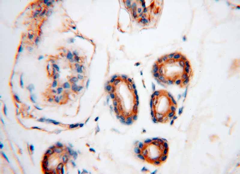 Immunohistochemical of paraffin-embedded human skin cancer using Catalog No:110867(GARS antibody) at dilution of 1:50 (under 40x lens)