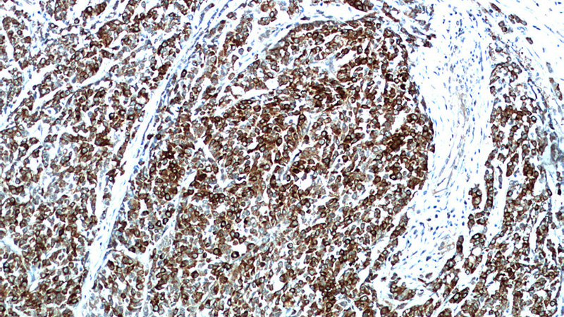 Immunohistochemical of paraffin-embedded human colon cancer using Catalog No:111698(HSPA4 antibody) at dilution of 1:100 (under 10x lens)