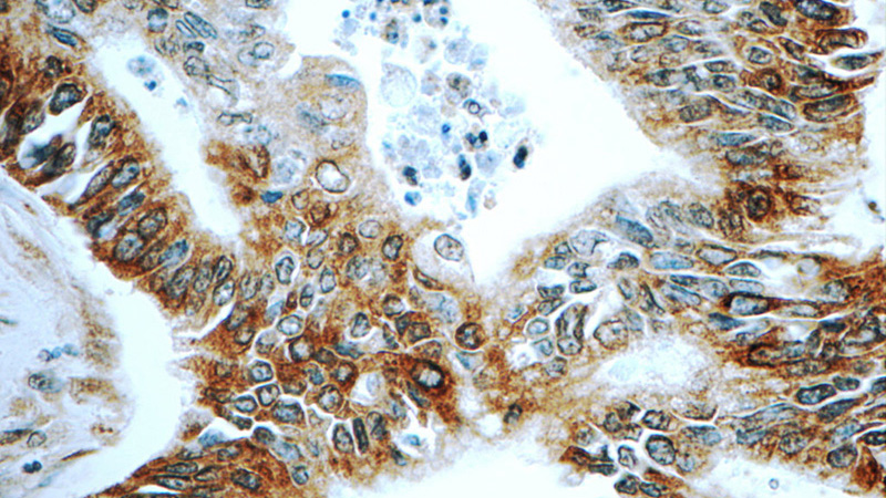 Immunohistochemistry of paraffin-embedded human pancreas cancer tissue slide using Catalog No:108401(BACE1 Antibody) at dilution of 1:50 (under 40x lens)