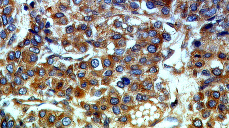 Immunohistochemical of paraffin-embedded human liver cancer using Catalog No:115192(SERINC1 antibody) at dilution of 1:50 (under 40x lens)