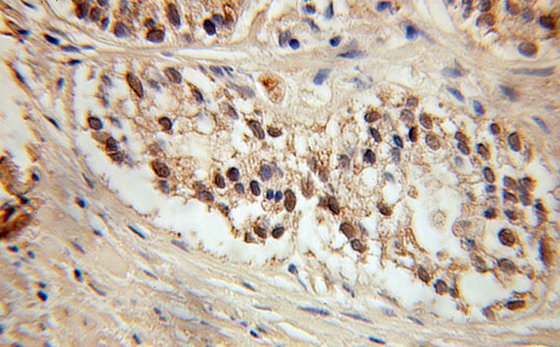 Immunohistochemical of paraffin-embedded human prostate cancer using Catalog No:109202(CGGBP1 antibody) at dilution of 1:100 (under 10x lens)