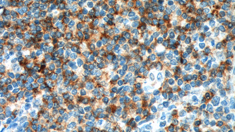 Immunohistochemistry of paraffin-embedded human tonsillitis tissue slide using Catalog No:109035(CD4 Antibody) at dilution of 1:200 (under 40x lens). heat mediated antigen retrieved with Tris-EDTA buffer(pH9).