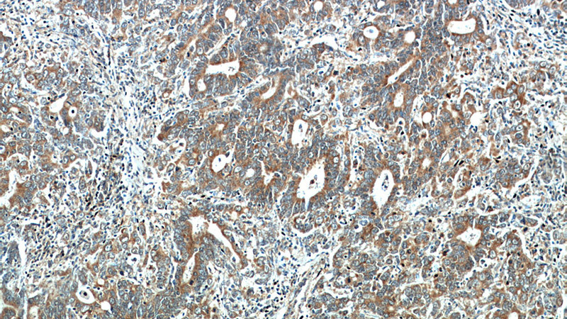 Immunohistochemical of paraffin-embedded human stomach cancer using Catalog No:111990(KIAA1199 antibody) at dilution of 1:50 (under 10x lens)