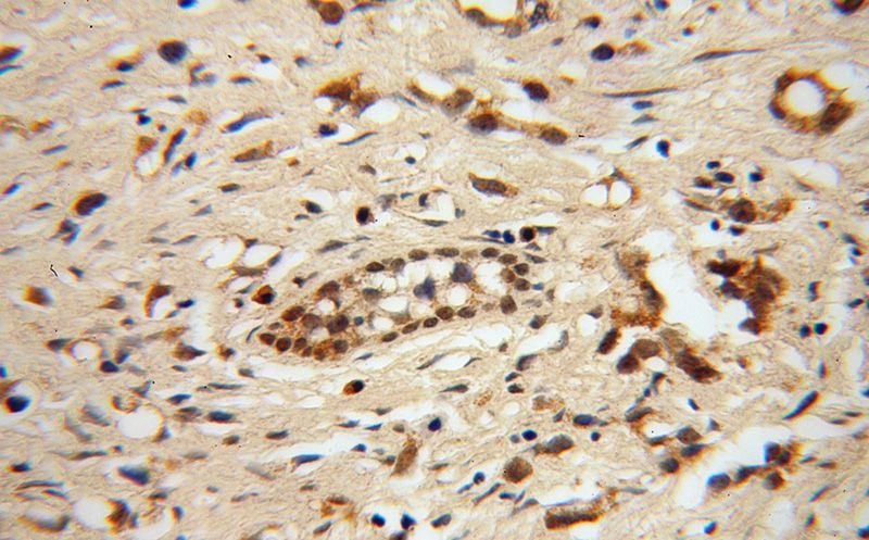 Immunohistochemical of paraffin-embedded human gliomas using Catalog No:107774(ADAR1 antibody) at dilution of 1:50 (under 40x lens)