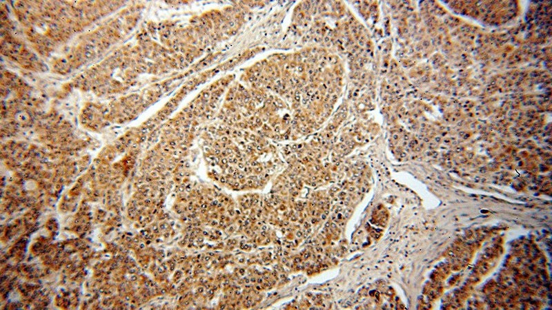Immunohistochemical of paraffin-embedded human liver cancer using Catalog No:114427(RAB27B antibody) at dilution of 1:50 (under 10x lens)