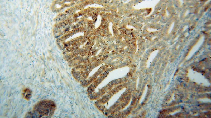 Immunohistochemical of paraffin-embedded human endometrial cancer using Catalog No:116042(THEM4 antibody) at dilution of 1:50 (under 10x lens)