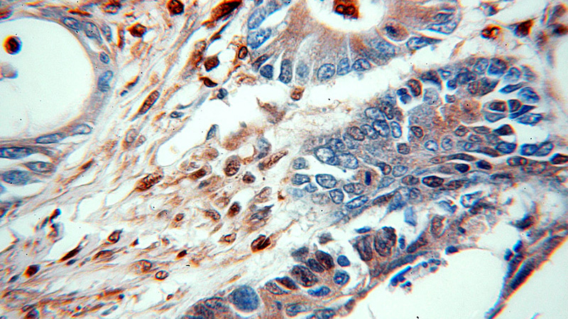 Immunohistochemical of paraffin-embedded human ovary tumor using Catalog No:113672(PD-ECGF antibody) at dilution of 1:50 (under 40x lens)