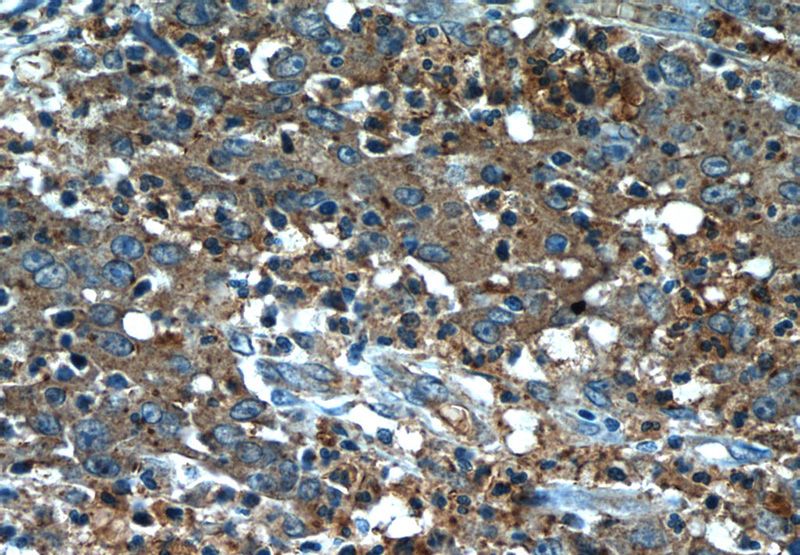 Immunohistochemistry of paraffin-embedded human colon cancer tissue slide using Catalog No:116495(TUSC2 Antibody) at dilution of 1:50 (under 40x lens)