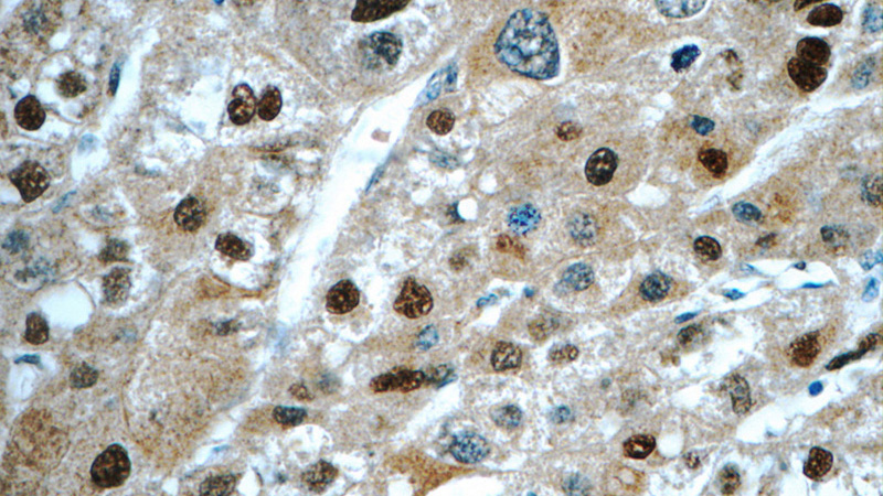 Immunohistochemistry of paraffin-embedded human liver cancer tissue slide using Catalog No:113349(ONECUT1 Antibody) at dilution of 1:50 (under 40x lens)