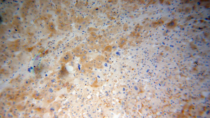 Immunohistochemical of paraffin-embedded human liver cancer using Catalog No:112955(NARS antibody) at dilution of 1:100 (under 10x lens)