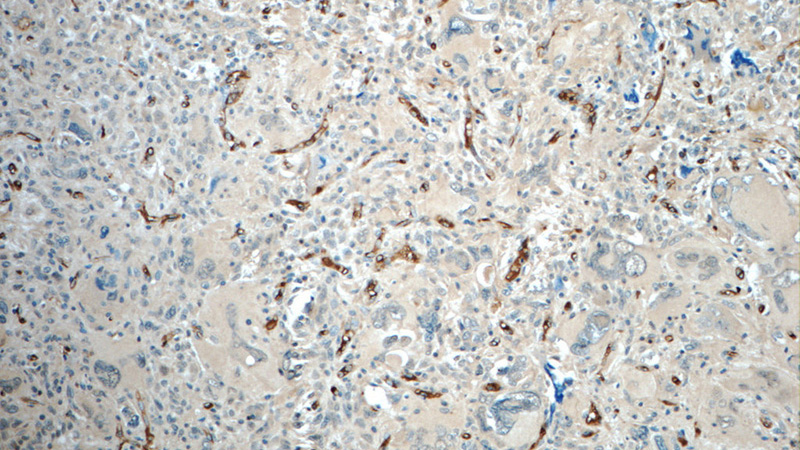 Immunohistochemistry of paraffin-embedded human gliomas tissue slide using Catalog No:110869(GAS1 Antibody) at dilution of 1:50 (under 10x lens)